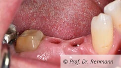 Abb. 1: Präparierter Zahn und inserierte Implantate